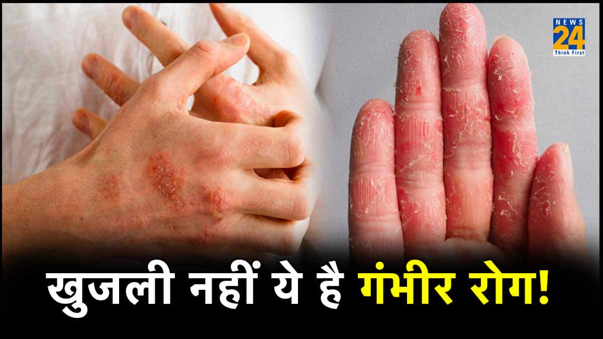 Eczema को खुजली की समस्या समझना सही? जानिए अंतर, प्रकार और इलाज