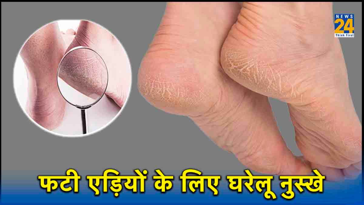 HOME REMEDIES : कुछ घरेलू नुस्खे अपनाकर एकदम मुलायम हो जाएगी आपकी फटी एड़ियां