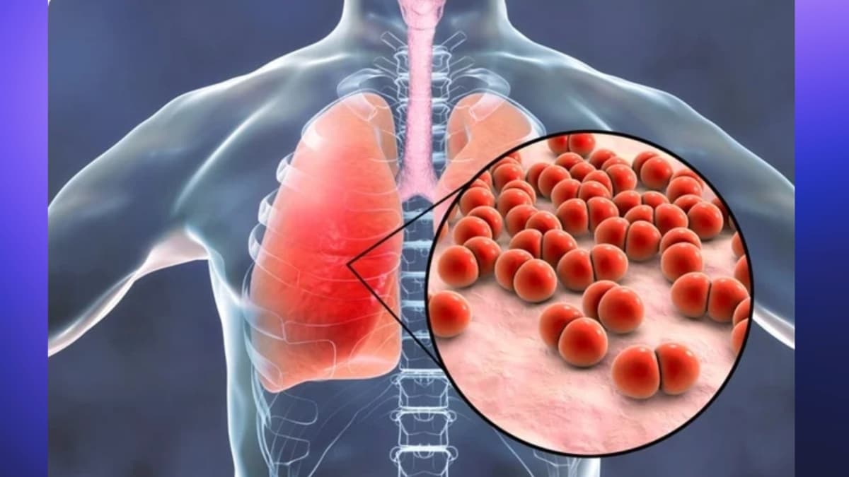 pneumonia
