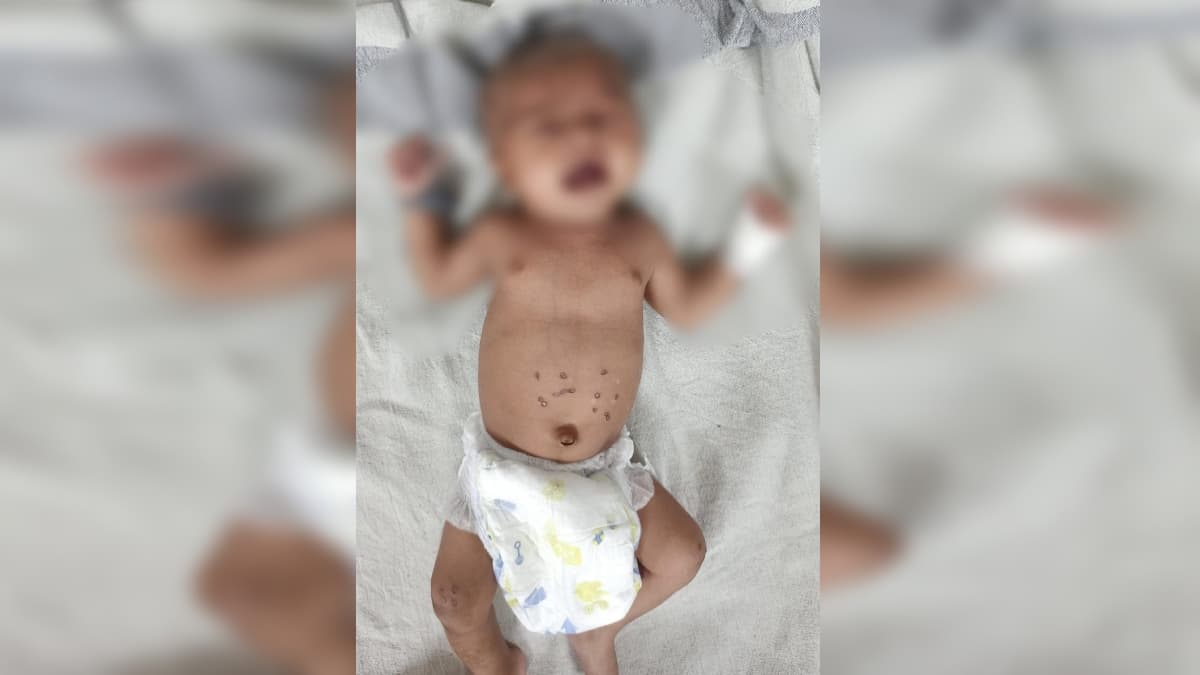 शहडोल में 5 माह के मासूम को 21 बार दागा, जानें क्या है डाॅम प्रथा जिसका शिकार बनते हैं बच्चे
