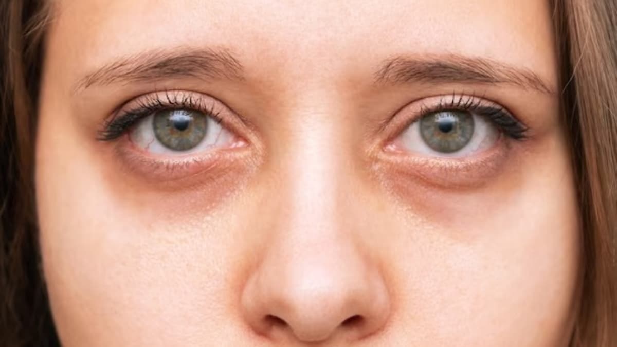 Dark Circles ने छीन ली दमकती त्वचा? तो ये 5 घरेलू नुस्खे जरूर करें ट्राई