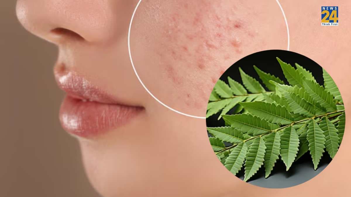 मुहांसों के लिए Neem का उपयोग कैसे करें? घर पर बनाएं 2 फेस पैक, त्वचा दमक उठेगी
