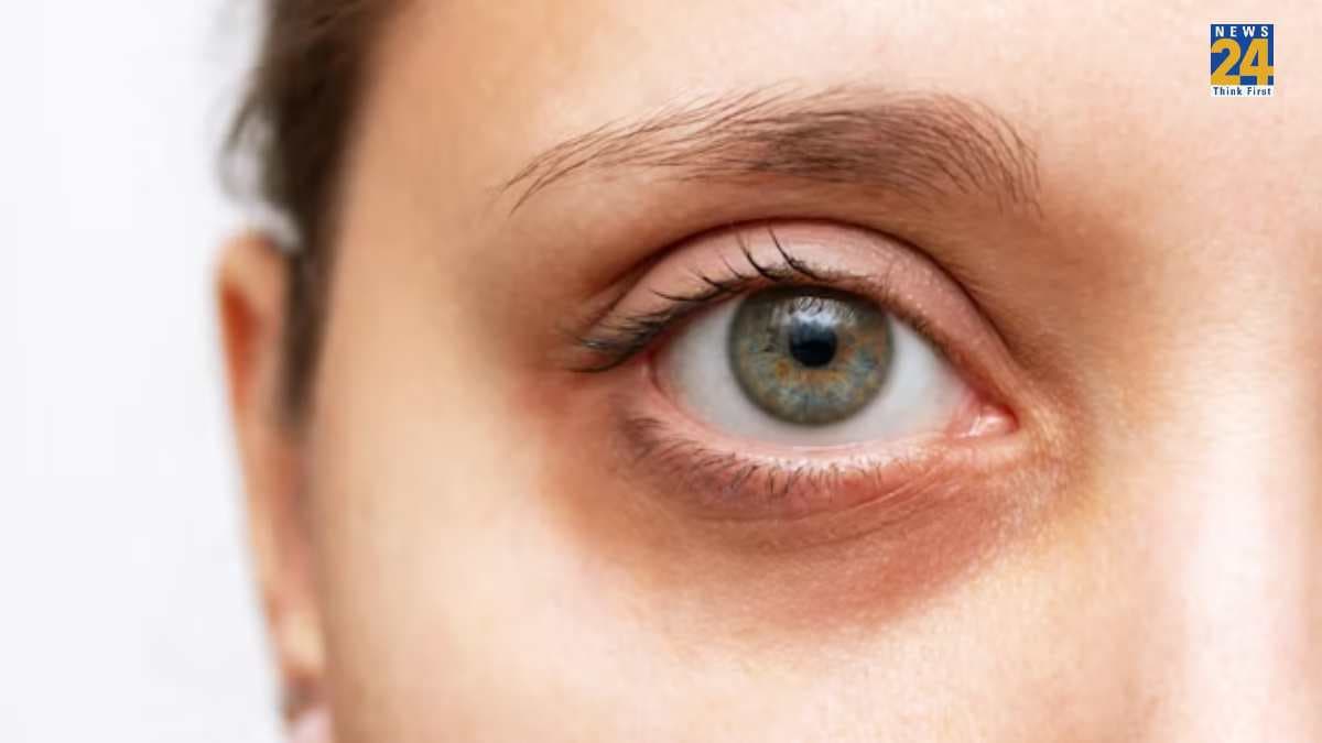 Dark Circles क्यों होते हैं? कैसे इस समस्या में राहत पा सकते हैं, जानें Expert की सलाह