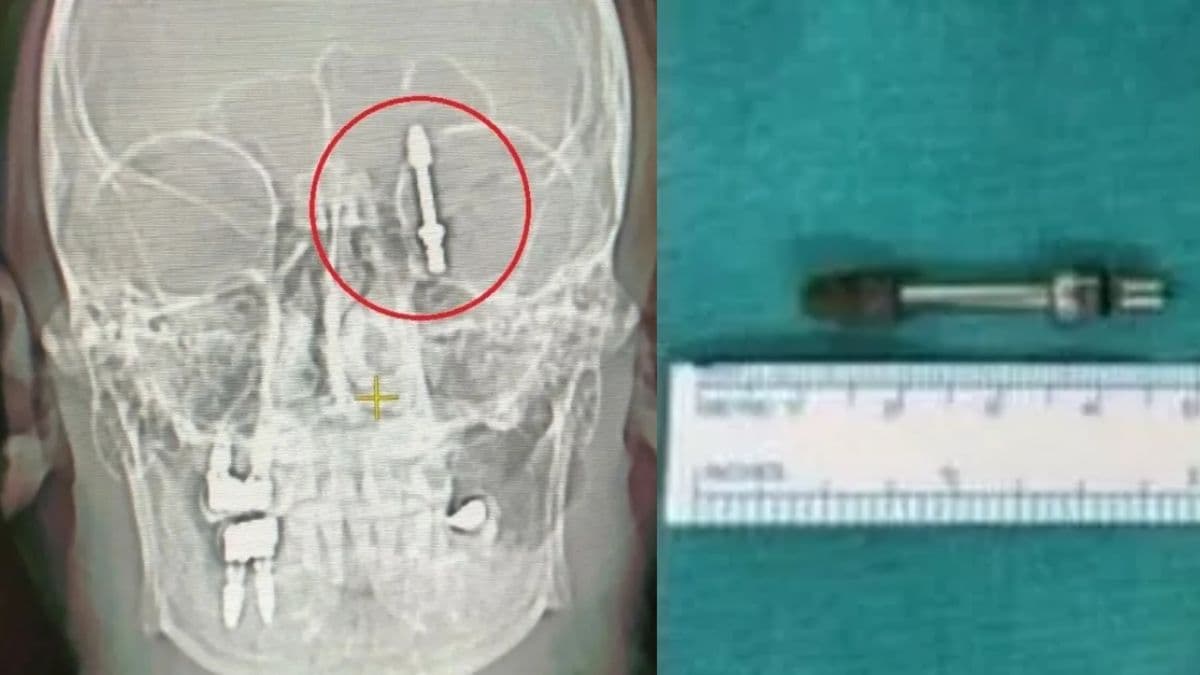 जबड़ा तोड़ दिमाग में पहुंच गया स्क्रू, ऑपरेशन टेबल पर मरीज को छोड़ भागा डॉक्टर