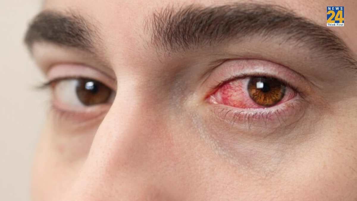 सावधान! गर्मियों में भी हो सकता है आई फ्लू; अभी जान लें बचाव के टिप्स