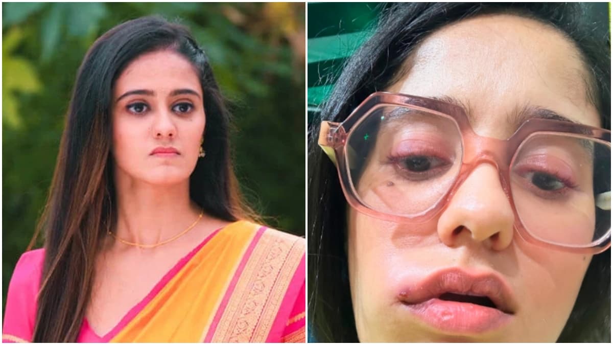 गुम है किसी के प्यार में… फेम एक्ट्रेस का चेहरा सूजा, Ayesha Singh ने दिखाया, अब कैसी हालत?