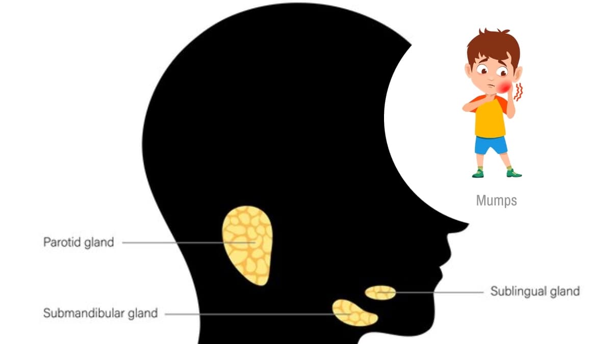 बढ़ रहे Mumps के मामले! इस वायरस के बारे में जानें सबकुछ