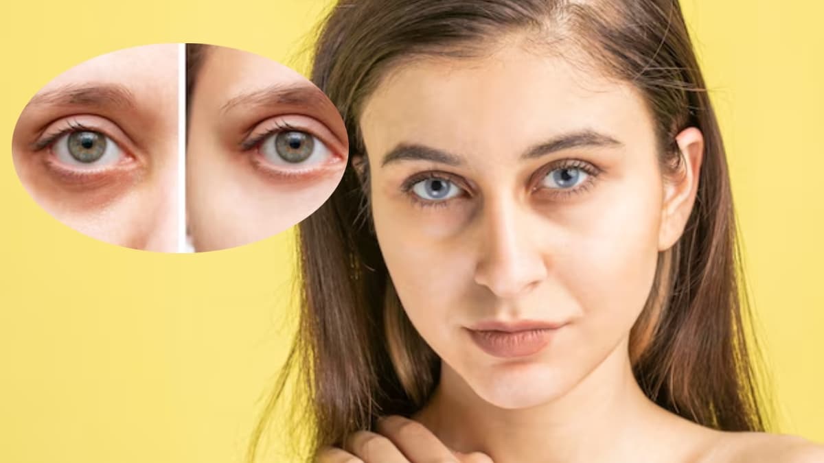 आंखों के नीचे काले घेरे? यहां जानें कारण और बचाव