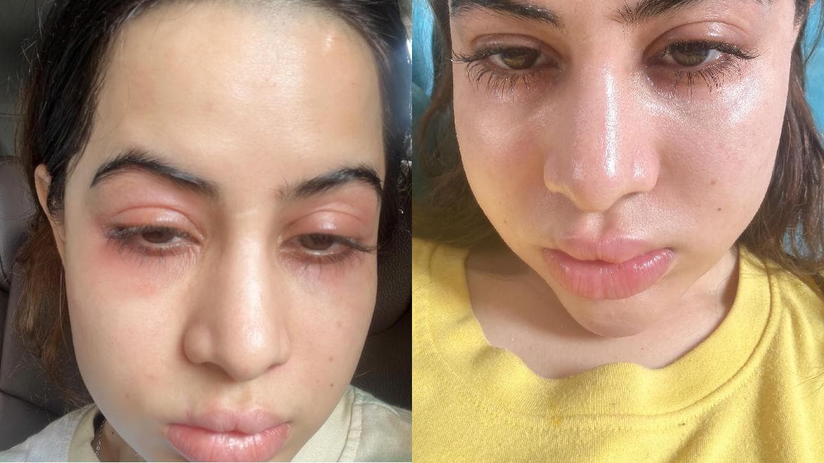 Urfi Javed Swollen Face Reason