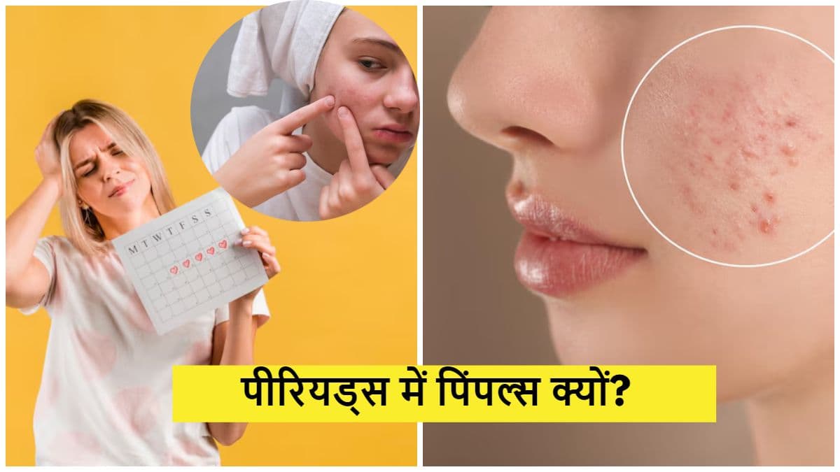Period Acne: पीरियड्स के दौरान खो जाता है चेहरे का नूर? एक्सपर्ट से जानें पिंपल्स होने के कारण और बचाव