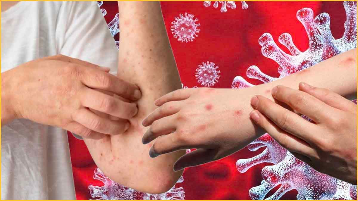 सावधान! MPOX के लक्षण बेहद खतरनाक! मरीज ने सुनाई आपबीती, बोला- दर्द इतना पूरी रात तड़पा