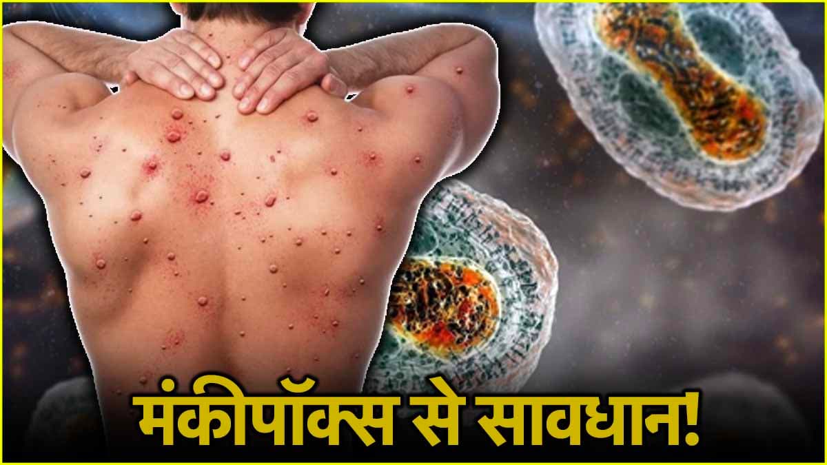 Monkey Pox Alert: AIIMS की गाइडलाइंस जारी, मरीज में ऐसे लक्षण दिखें तो तुरंत करें आइसोलेट