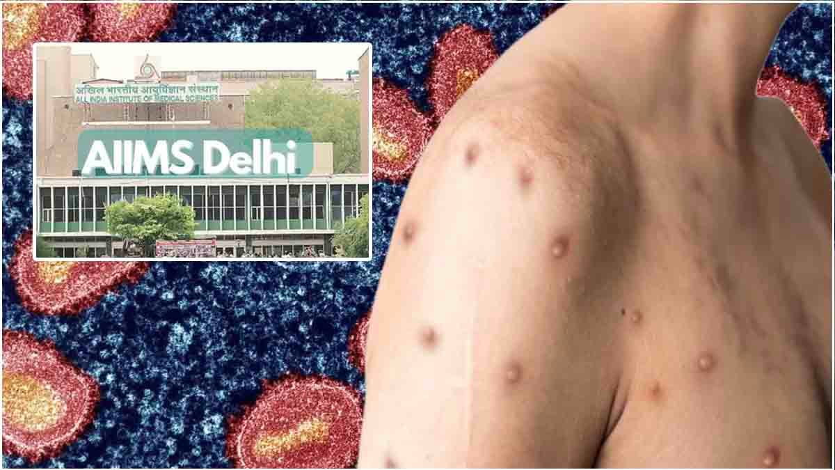 MPox के संदिग्ध मरीज की AIIMS दिल्ली में दस्तक, जानें जांच रिपोर्ट में क्या आया सामने?