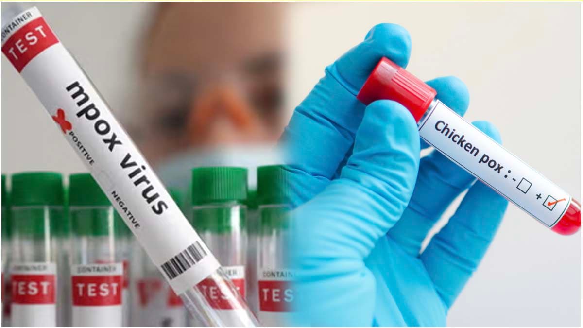 Mpox vs Chickenpox: मंकीपॉक्स को चिकन पॉक्स समझने की न करें गलती, दोनों में हैं ये अंतर