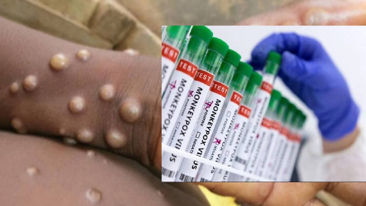 हो जाएं अलर्ट, इंडिया में मिला MonkeyPox का पहला संदिग्ध मरीज, हेल्थ मिनिस्ट्री ने उठाया ये बड़ा कदम