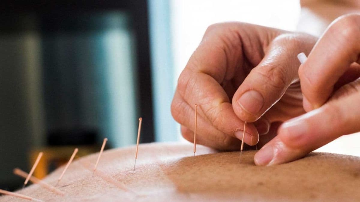 acupuncture