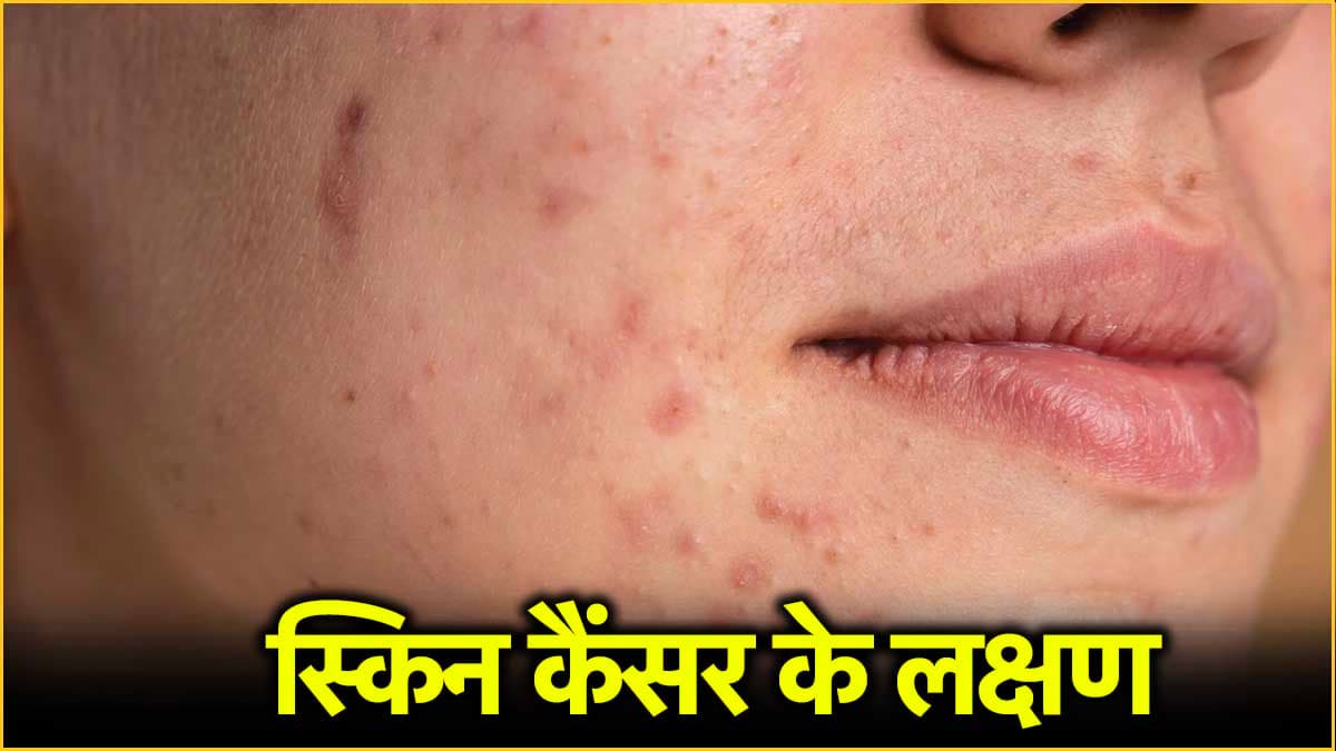 Skin Cancer: कैंसर का संकेत भी है चेहरे पर लाल धब्बे होना! जानें बचाव के तरीके