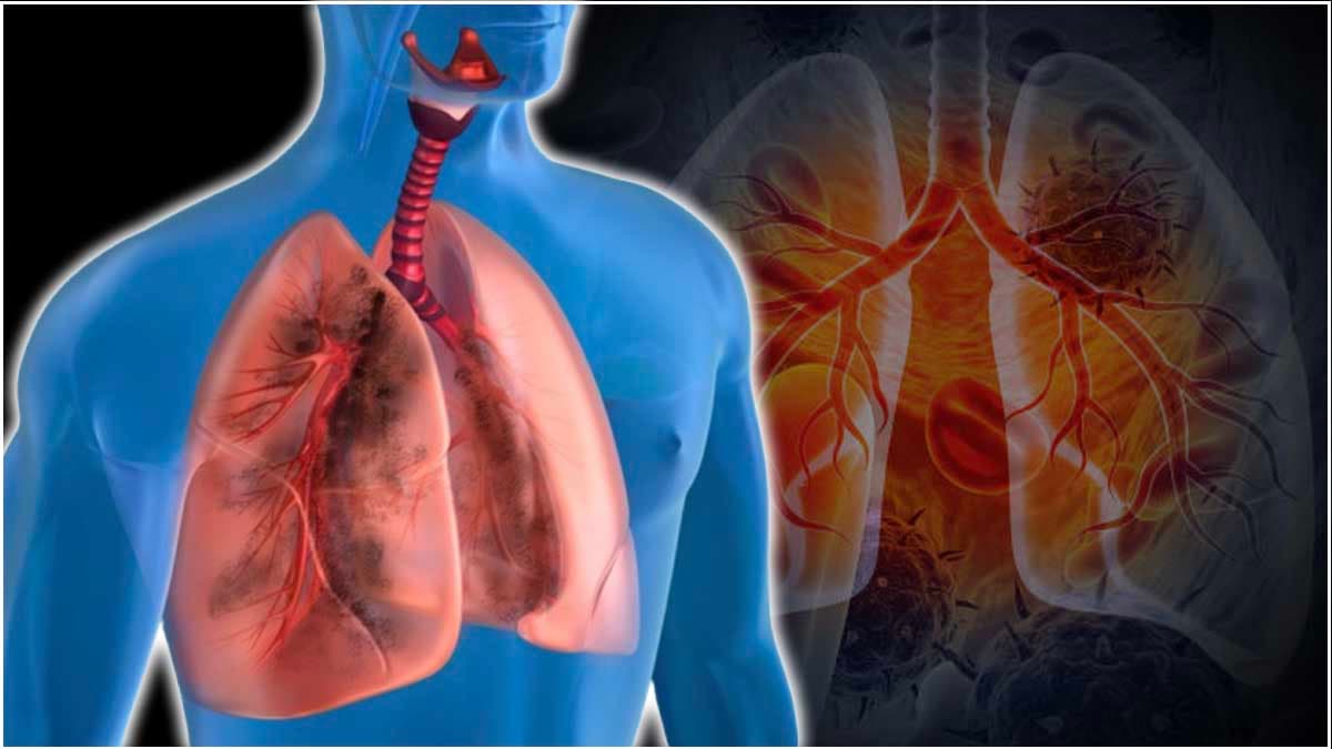 Lung Disease को बुलावा देती हैं ये 7 आदतें! धीरे-धीरे शरीर पर ऐसे करती हैं हमला