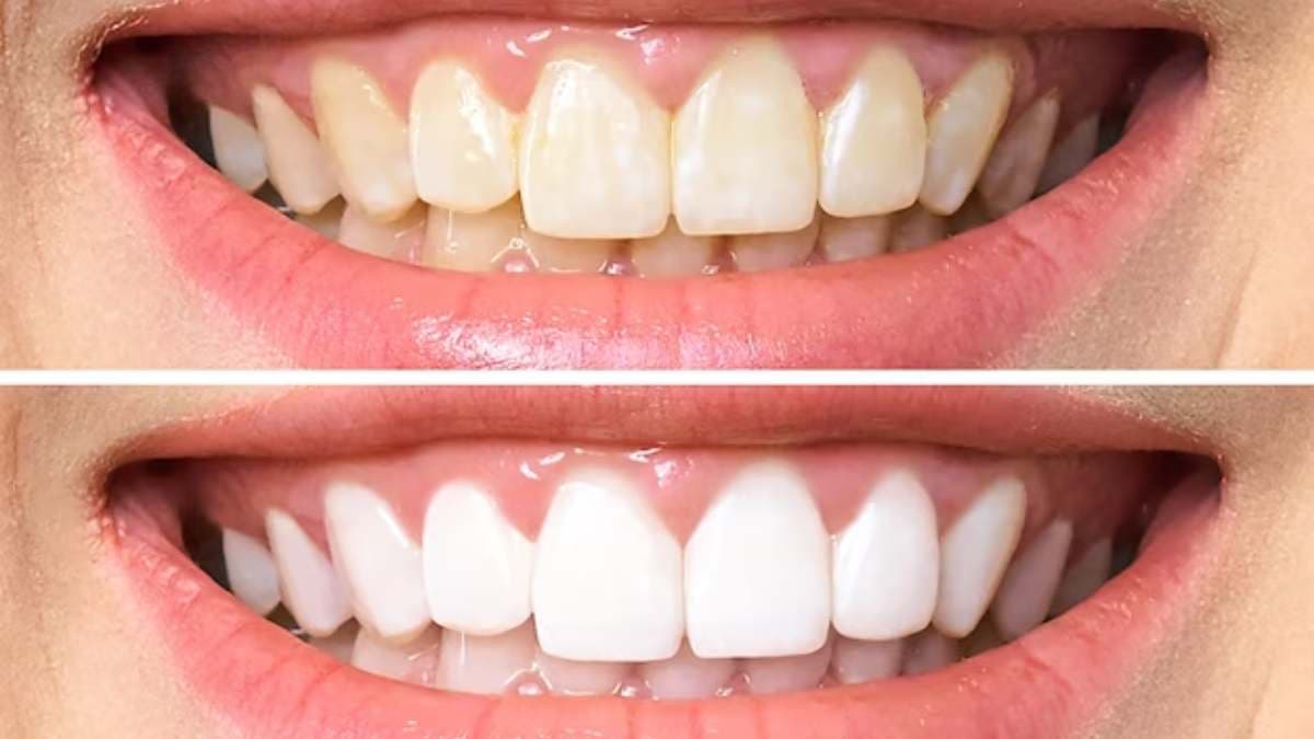 Teeth Brightening: पीले दांतों से हमेशा-हमेशा के लिए छुटकारा दिलाएगी यह जोड़ी, फॉलो करें सिंपल घरेलू नूस्खा