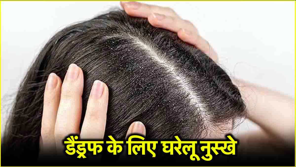 Dandruff Home Remedies: जिद्दी डैंड्रफ भगाएं, ये 7 दमदार तरीके अपनाएं
