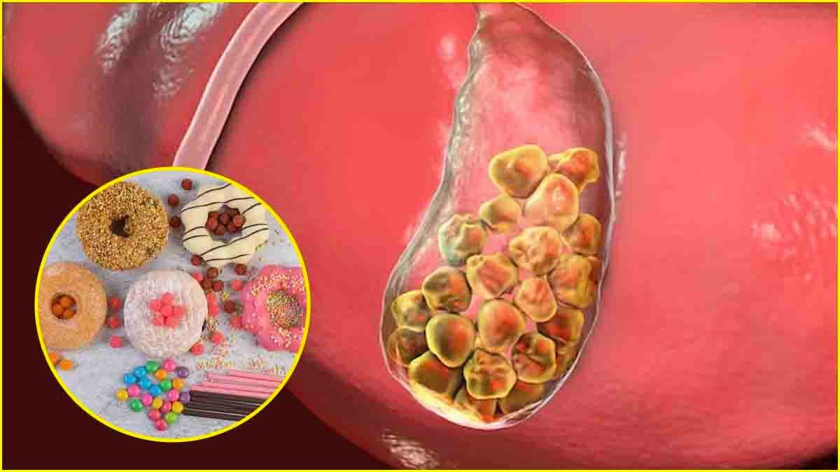 Stones Causing Food: ब्रेड समेत इन 5 चीजों से होती है पथरी! आज से ही बना लें दूरी