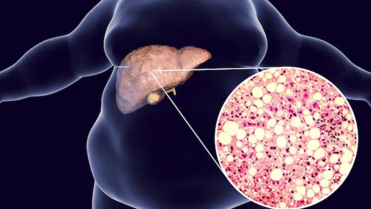 Fatty Liver Treatment: एक चुटकी हल्दी लिवर को तंदुरुस्त करने में है मददगार! जानें अपनाने का तरीका और फायदा