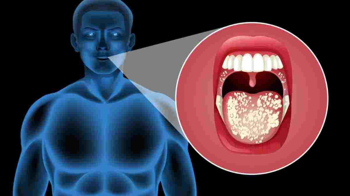 Mouth Cancer: रोजमर्रा की ये 5 आदतें हैं मुंह के कैंसर का बुलावा, जानें संकेत और बचाव