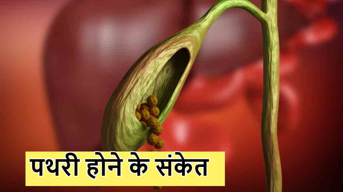 Gallstones Symptoms: ये 5 संकेत बताएंगे पित्त की थैली में पथरी है या नहीं