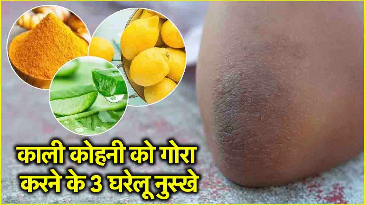Beauty Tips: चुटकियों में करें कोहनी और घुटनों के कालेपन को दूर, अपनाएं ये 3 घरेलू नुस्खे
