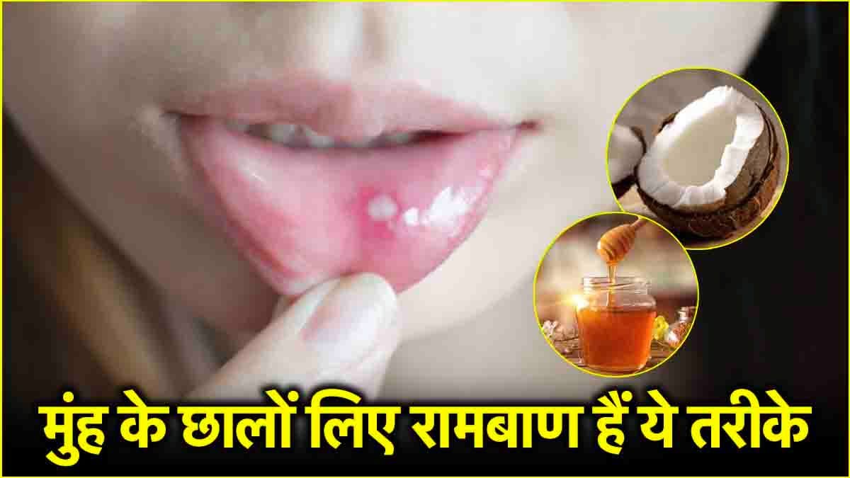 Mouth Ulcers: क्या आप भी हैं मुंह के छालों से परेशान? अपनाएं ये 3 घरेलू उपाय
