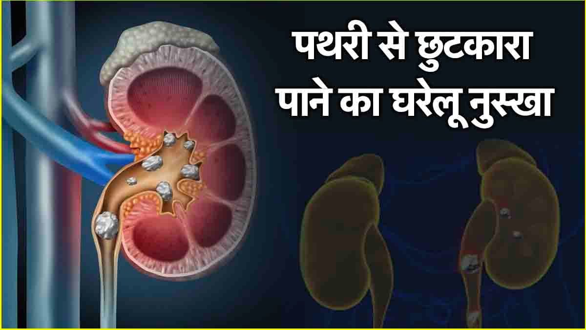बड़ी से बड़ी पथरी को गला देगा आचार्य मनीष का यह ड्रिंक, मरीज आज से ही करें सेवन