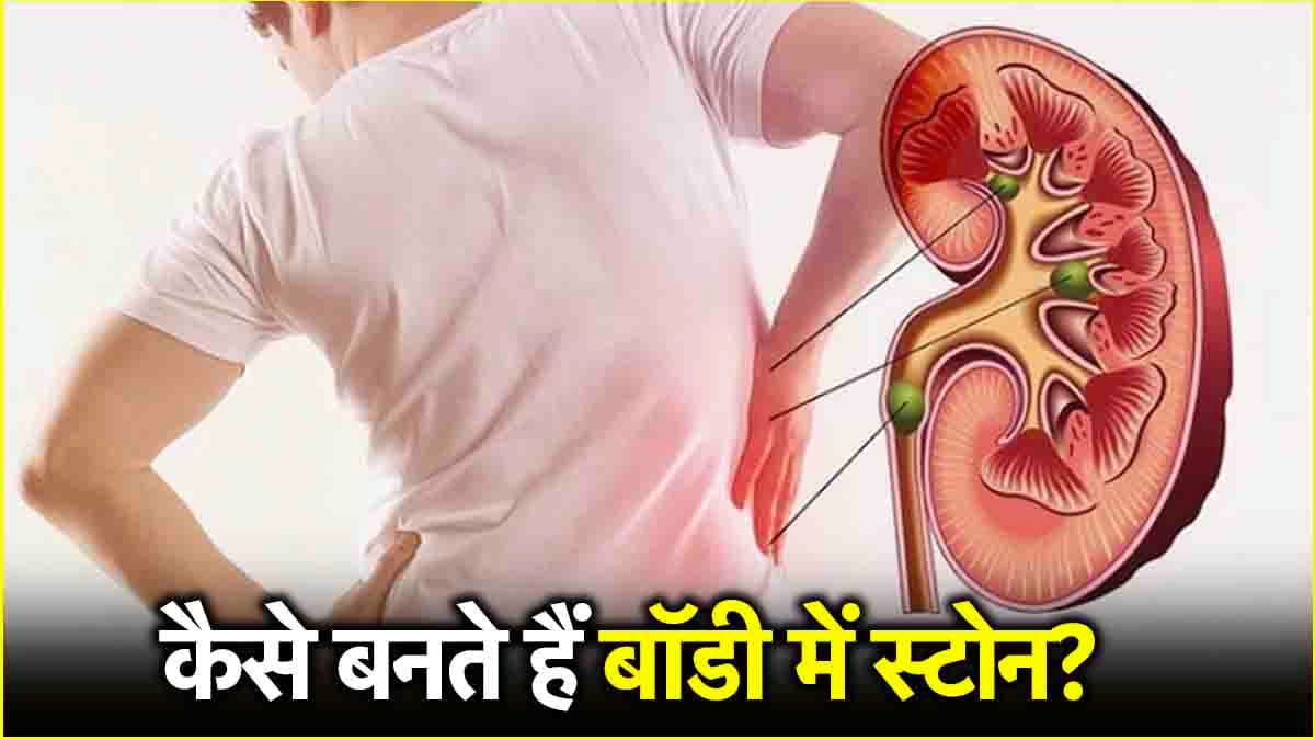 आखिर कैसे बनती है शरीर में पथरी? जानें शुरुआती संकेत व बचाव के तरीके