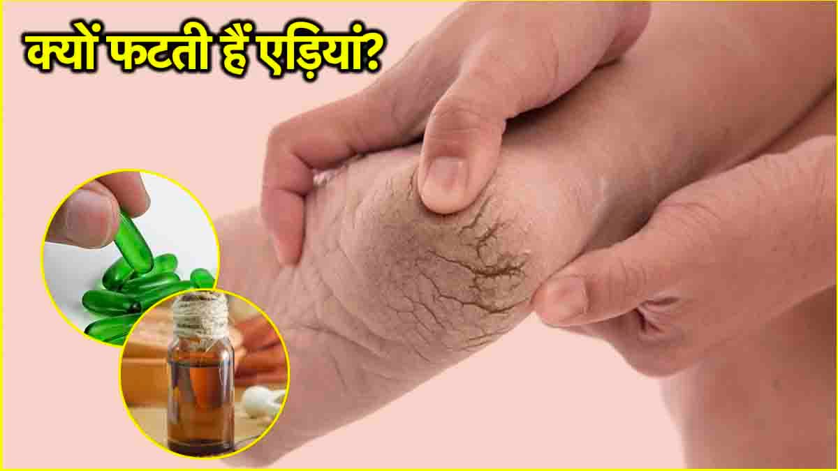 Cracked Heels: सर्दियों में एड़ियां फटने के शुरुआती संकेत, ठीक करने के आसान तरीके