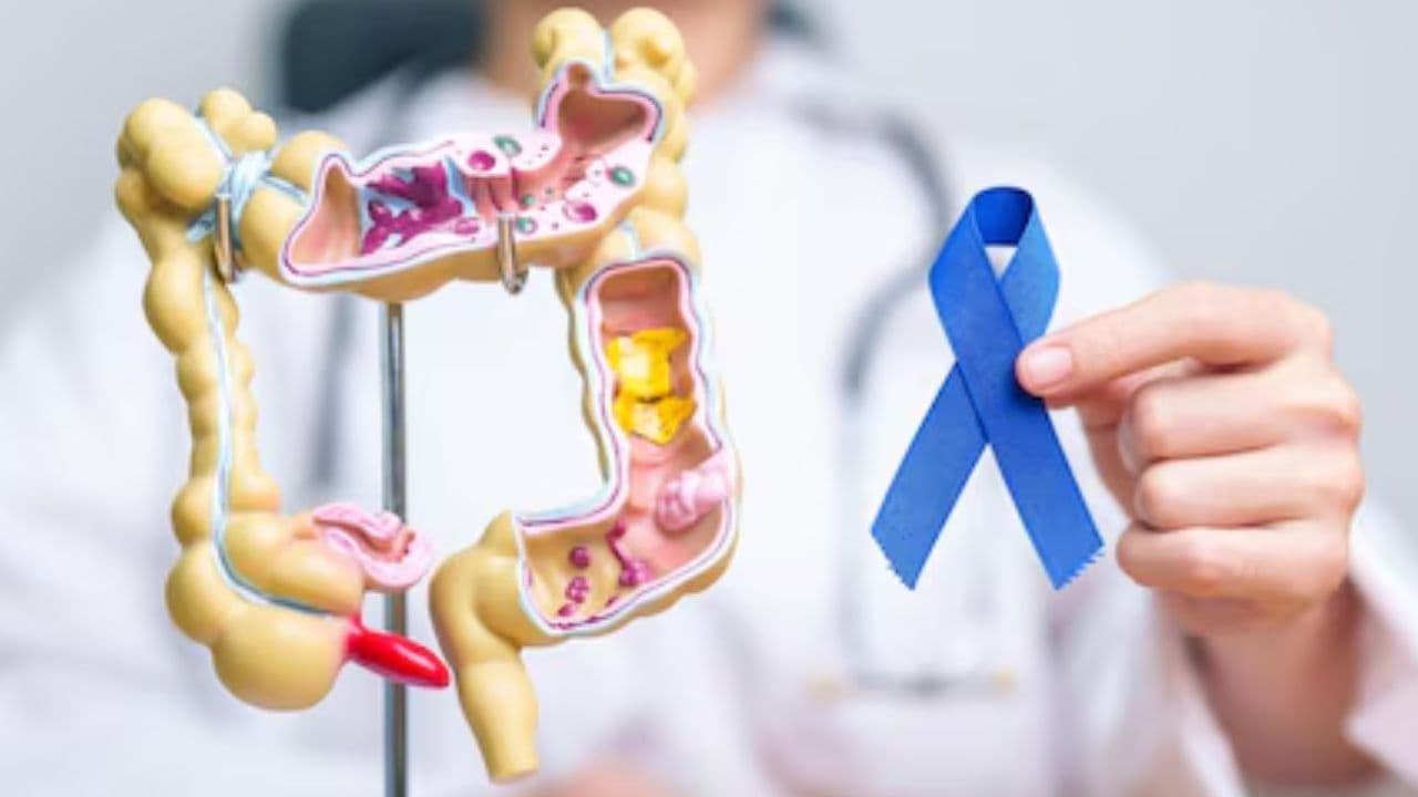 Bowel Cancer: युवाओं में बढ़ रहा आंतों के कैंसर का खतरा! लाइफस्टाइल में करें ये 3 बदलाव