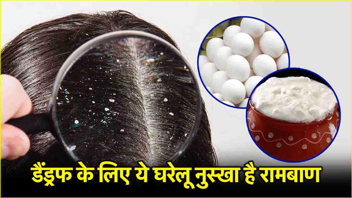Hair Care Tips: डैंड्रफ दूर करने के लिए घर पर बनाएं ये 3 हेयर मास्क, जानें इस्तेमाल करने का तरीका