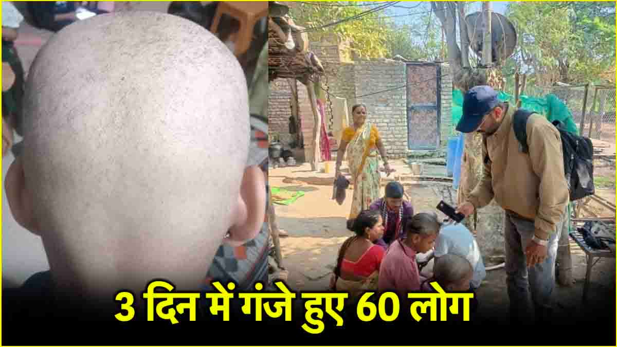 Weird Disease: रहस्यमयी बीमारी फैली, महाराष्ट्र के बुलढाना में अपने आप गंजे होने लगे लोग