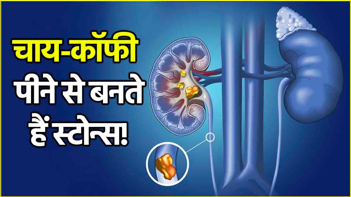 किडनी में क्यों होती है पथरी? डॉक्टर ने बताए 5 कॉमन कारण, ऐसे करें बचाव
