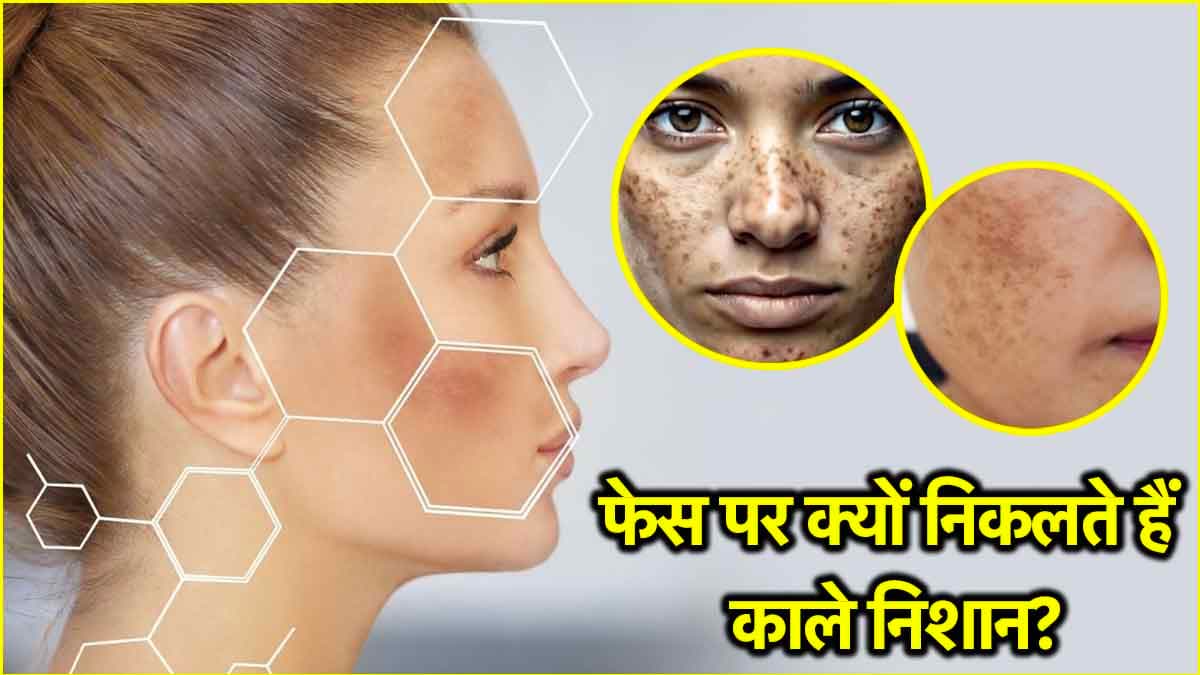 Skin Symptoms: शरीर पर काले धब्बे किस बीमारी के संकेत? जानें क्या कहते हैं एक्सपर्ट