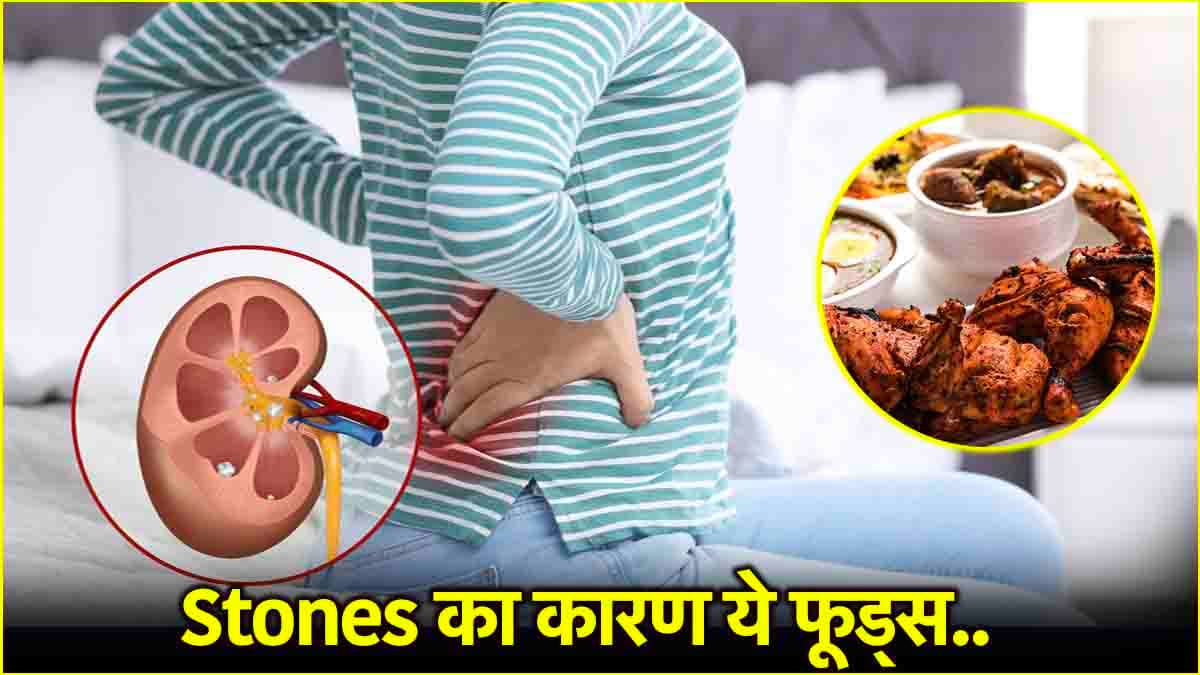 Kidney Stones का रिस्क बढ़ाती हैं ये चीजें, ज्यादा खाने से करें परहेज, क्या कहते हैं डॉक्टर?