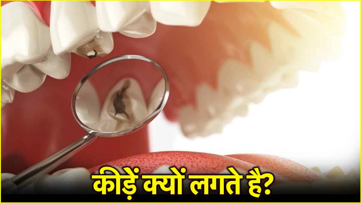 Cavity Causes: दांतों में कीड़ों को बढ़ावा देते हैं ये 5 फूड, जानें एक्सपर्ट एडवाइस