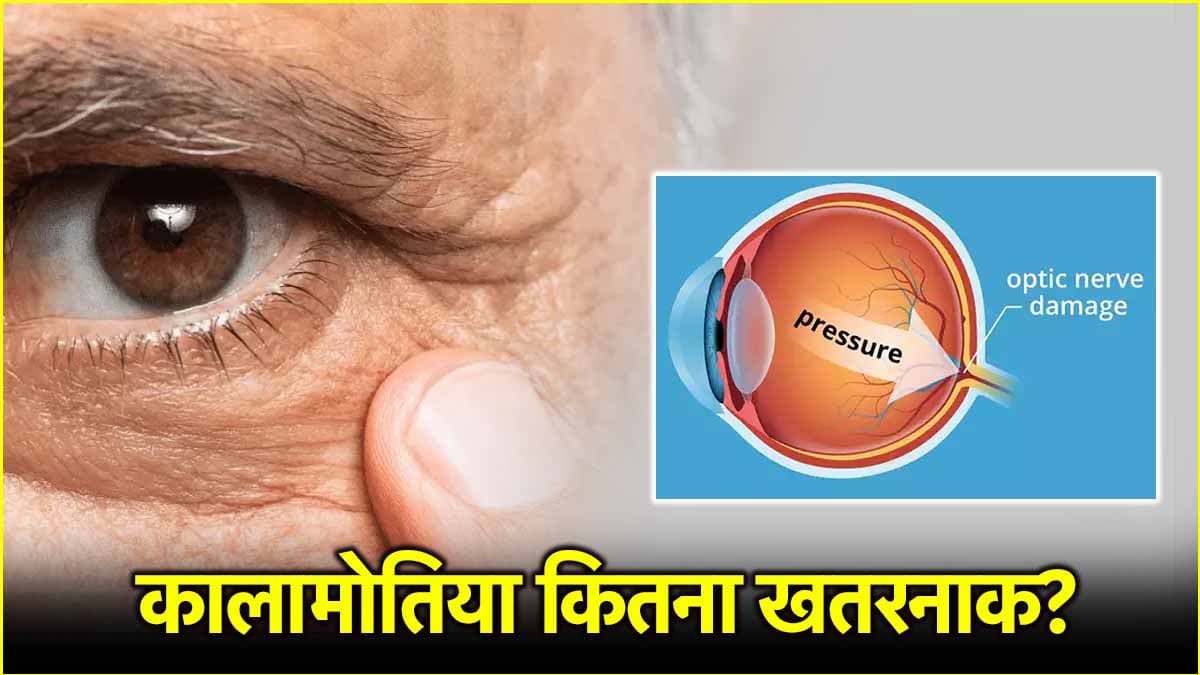 Glaucoma आंखों की कैसी बीमारी है? एक्सपर्ट्स से जानिए इससे बचने के तरीके