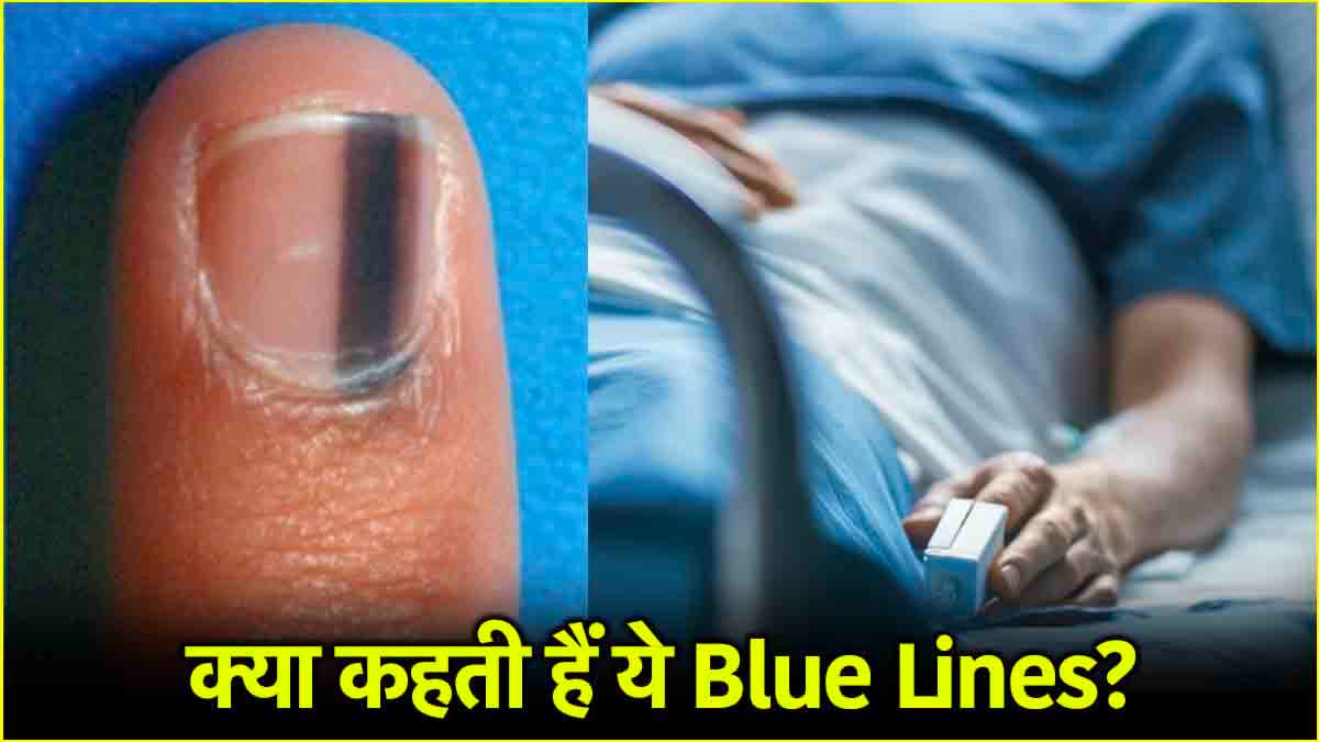 महिला के नाखून में दिख रही थीं 2 पतली लाइनें, जांच करवाने पर पता लगी यह गंभीर बीमारी