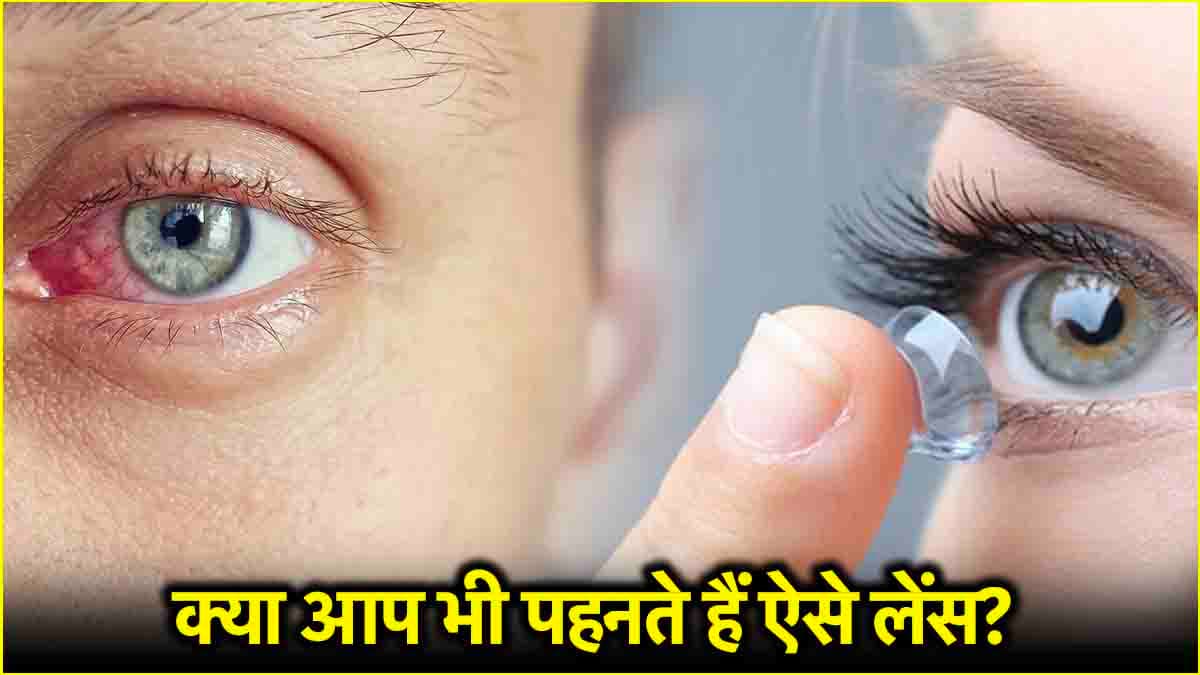Contact Lens से आंखों में इंफेक्शन! पीड़िता ने बताया कितना खतरनाक