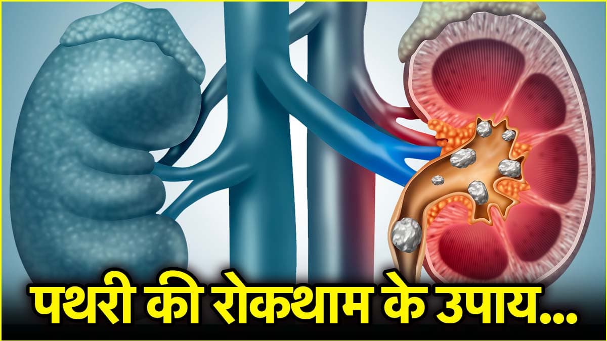 किडनी में बार-बार बन रही है पथरी? अपनाएं डॉक्टर के ये 3 Dietary टिप्स