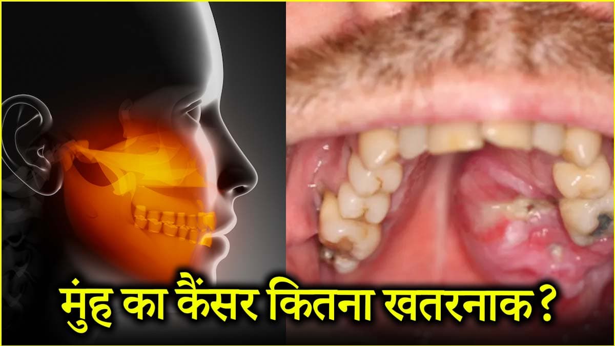 जबड़े का कैंसर कैसे होता है? जानें शुरुआती संकेत और इलाज