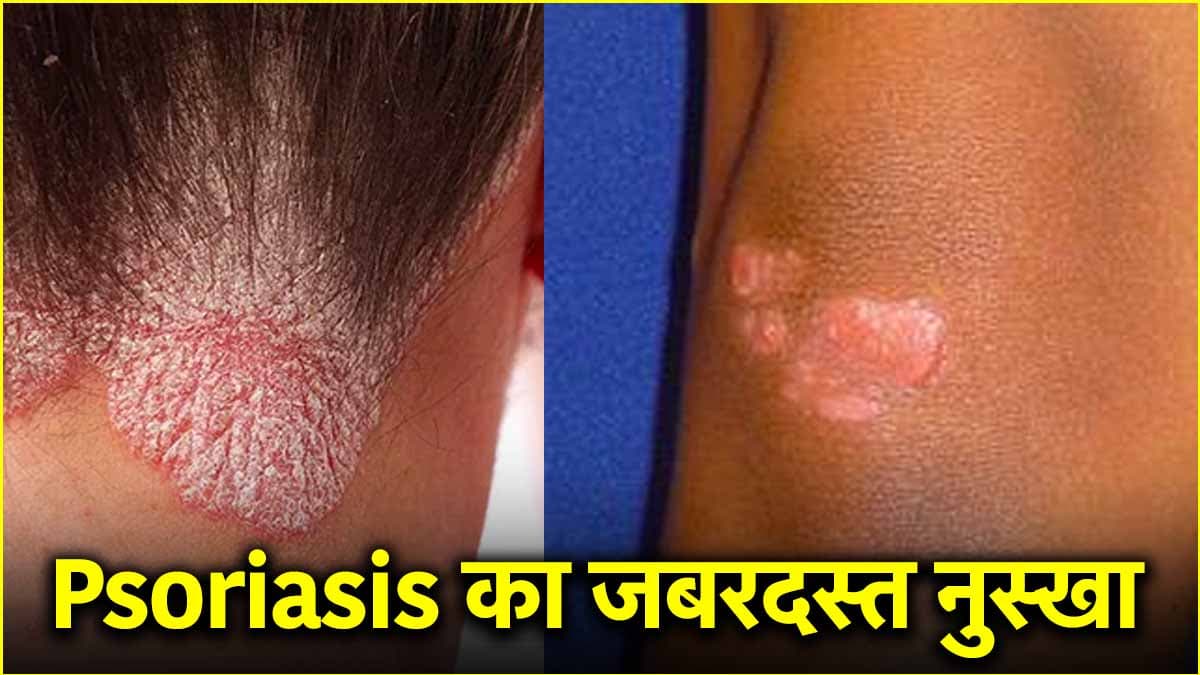 Psoriasis के मरीजों के लिए वरदान है ये उपाय! हकीम सुलेमान ने बताएं फायदे