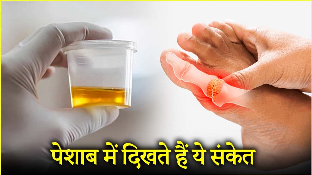 यूरिक एसिड ज्यादा हो तो पेशाब में दिखते 3 संकेत, जानें बचाव के तरीके