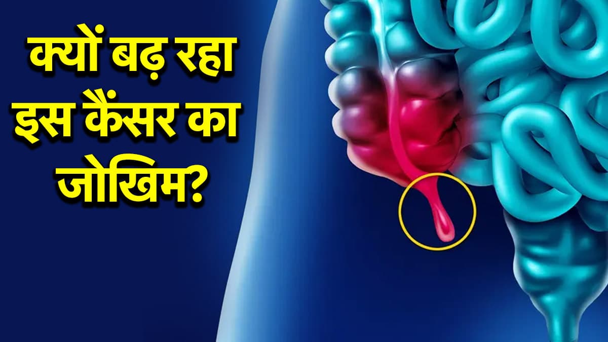 युवाओं के लिए साइलेंट किलर बन रहा है अपेंडिक्स कैंसर, डॉक्टर से जानें कारण और शुरुआती संकेत