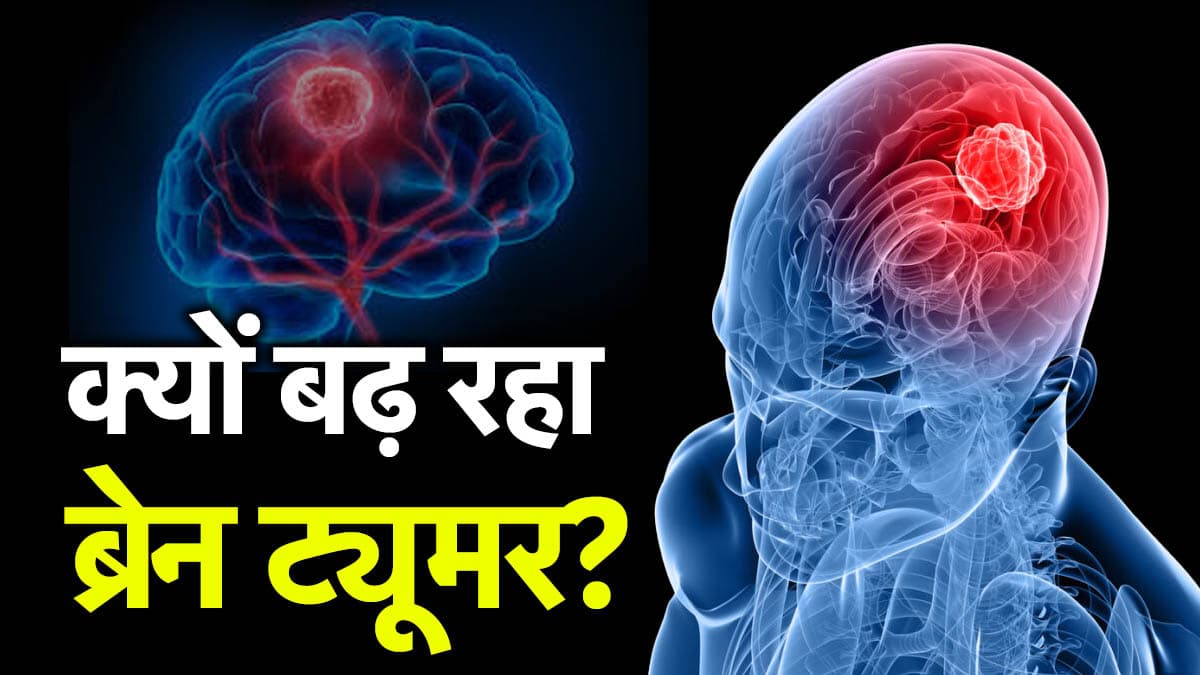World Brain Tumor Day: भारत में तेजी से बढ़ रहा ब्रेन ट्यूमर का रिस्क, मामूली लक्षण भी जानलेवा, जानें डॉक्टर की राय