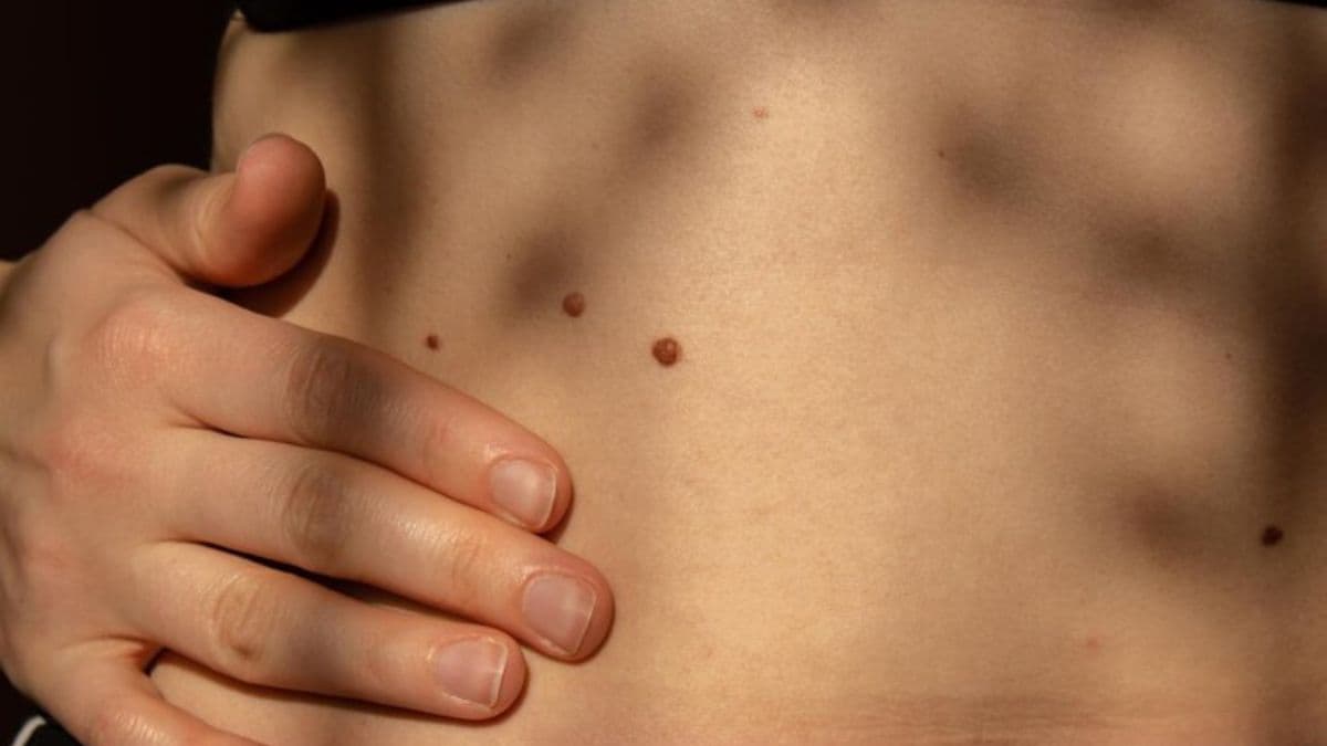Mole On Stomach